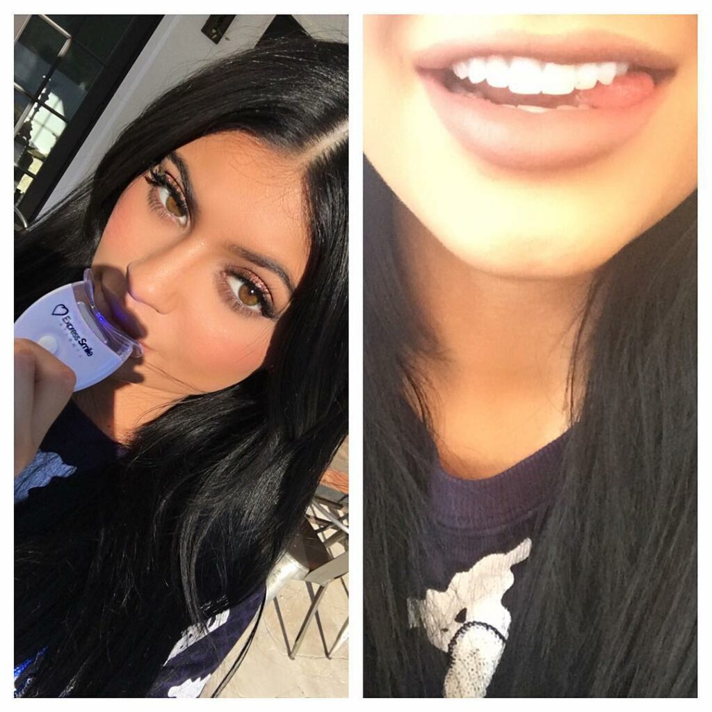 A little morning beauty session to start my day! The @expresssmileatlanta teeth ...