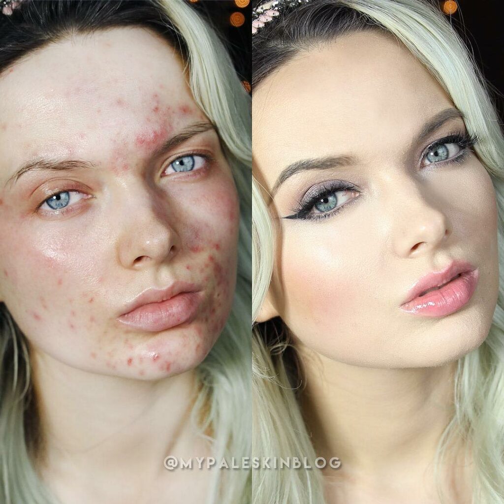 Kylie Jenner: #Day6 – I’m obsessed with Em Ford (@MyPaleSkinBlog). She’s a retired model and a… #Day6 - I’m obsessed with Em Ford (@MyPaleSkinBlog). She’s a retired model and a...