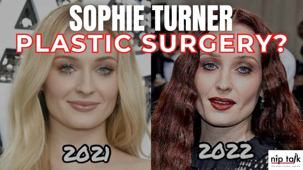 Sophie Turner Plastic Surgery? Did She Get Buccal Fat Removal?
