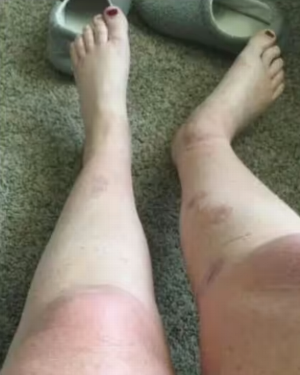 Picture of women's legs with burn marks over them