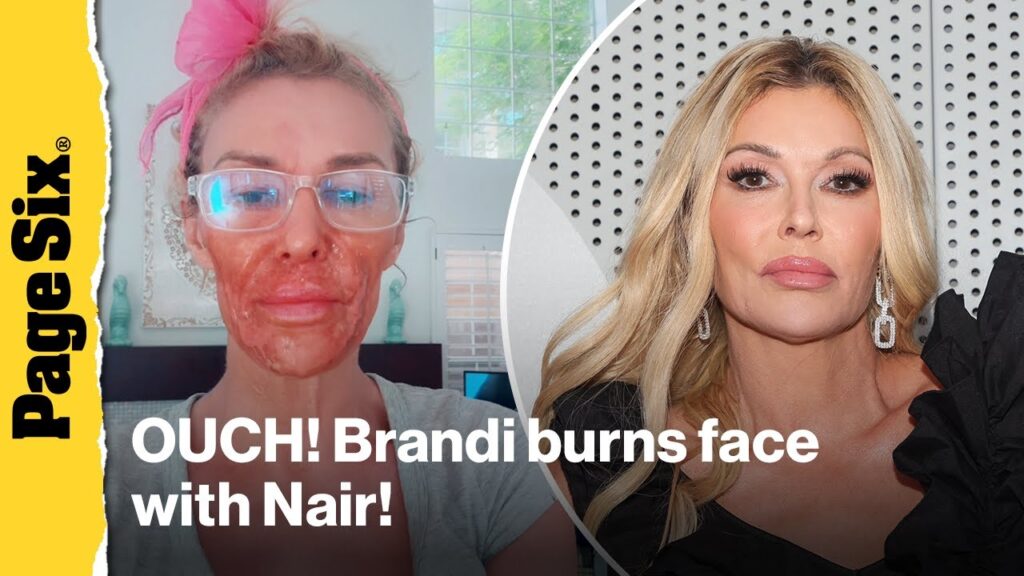 Brandi Glanville severely BURNS face in attempt to kill facial parasite Brandi Glanville severely BURNS face in attempt to kill facial parasite
