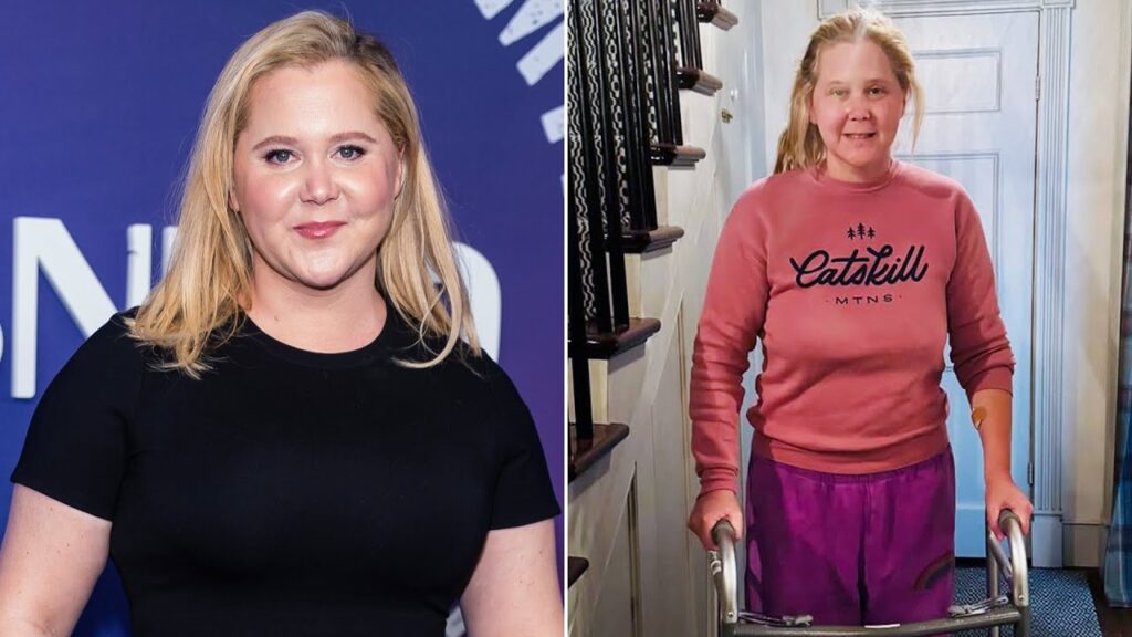 Amy Schumer Shares Update on Her Recovery After Back Surgery Amy Schumer Shares Update on Her Recovery After Back Surgery