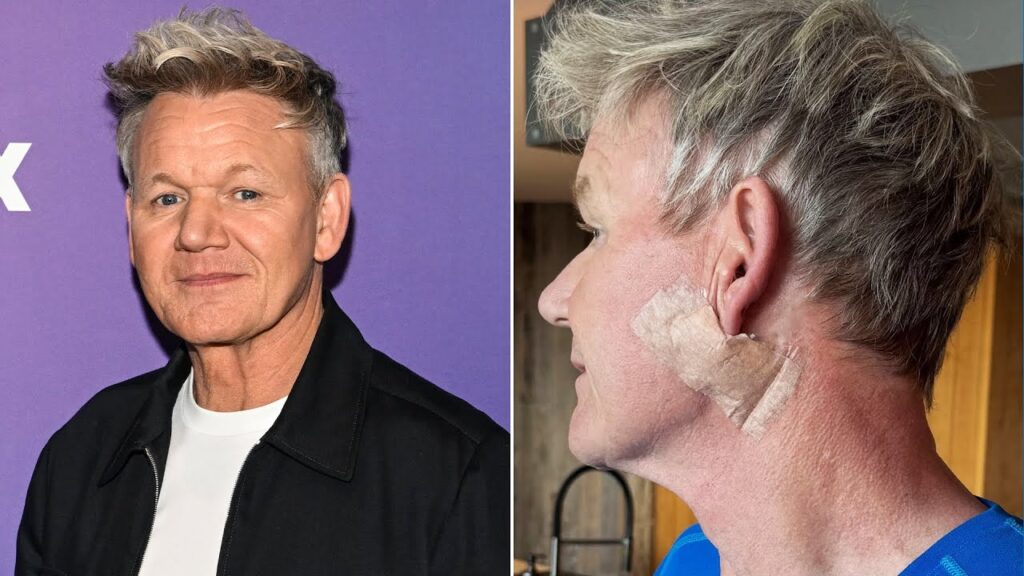 Gordon Ramsay Shares Skin Cancer Diagnosis Gordon Ramsay Shares Skin Cancer Diagnosis