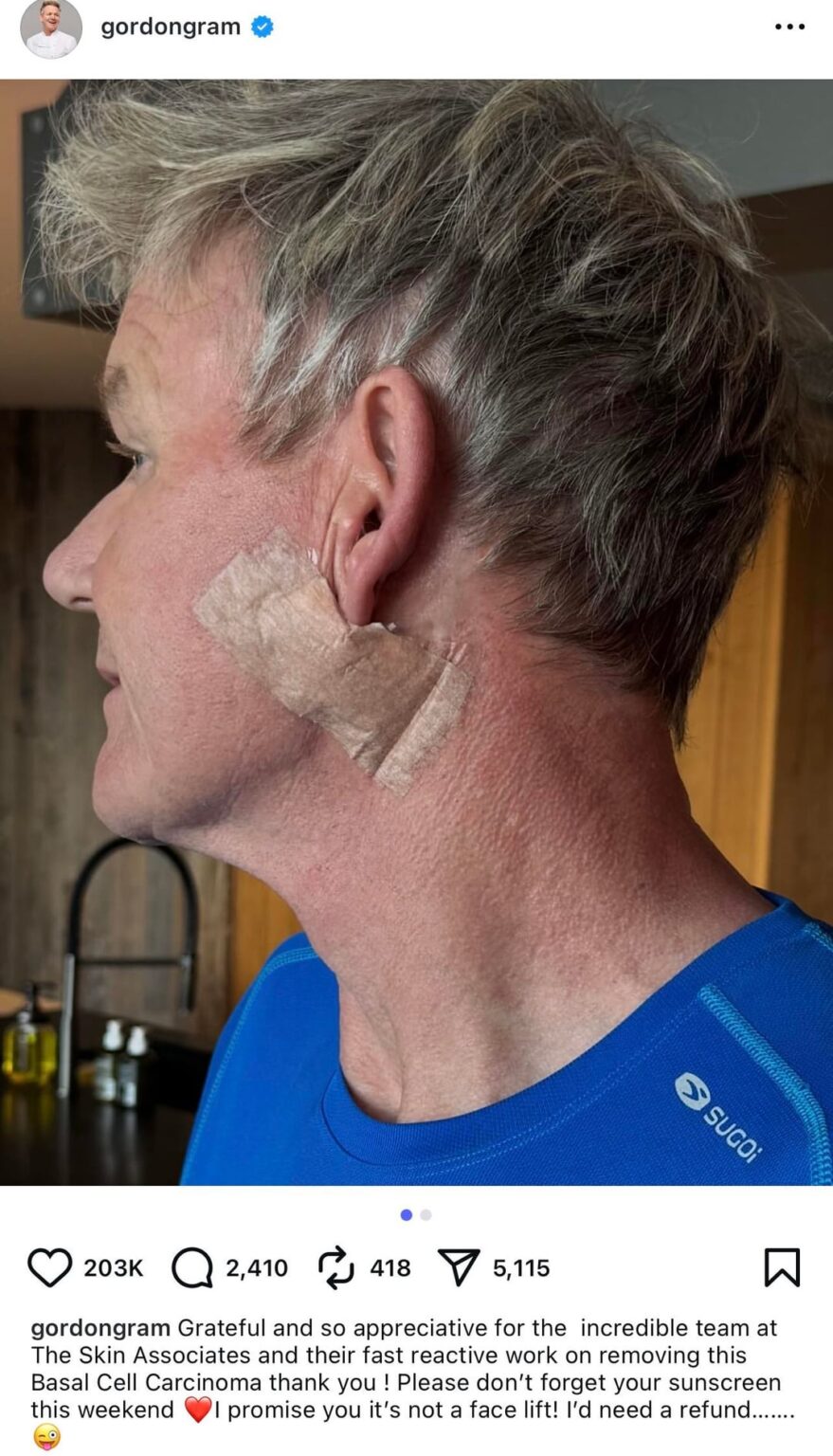 Gordon Ramsay Shares Skin Cancer Surgery Scar After Removing Basal Cell Carcinoma From His Face: ‘Don’t Forget Your Sunscreen'