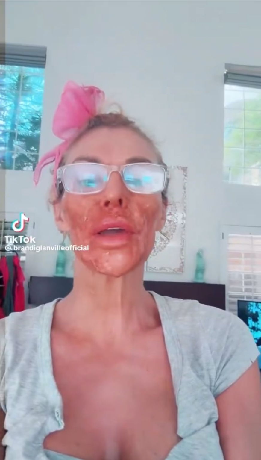 Brandi Glanville severely burns her face with Nair, hoping to draw out “Caroline” — a parasite living in her face.