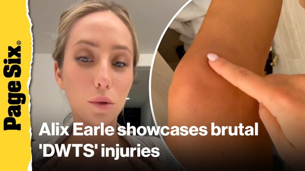 Alix Earle showcases brutal ‘DWTS’ injuries including bruises and missing toenail Alix Earle showcases brutal 'DWTS' injuries including bruises and missing toenail