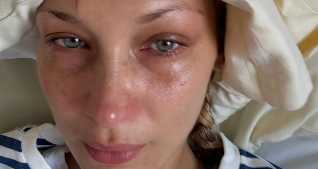 Bella Hadid Shares New Photos Seemingly from Hospital Bed | Bella Hadid | Just Jared: Celebrity News and Gossip