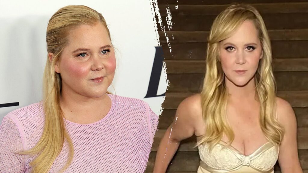 Amy Schumer’s weight loss tied to Cushing's syndrome — here’s what to know