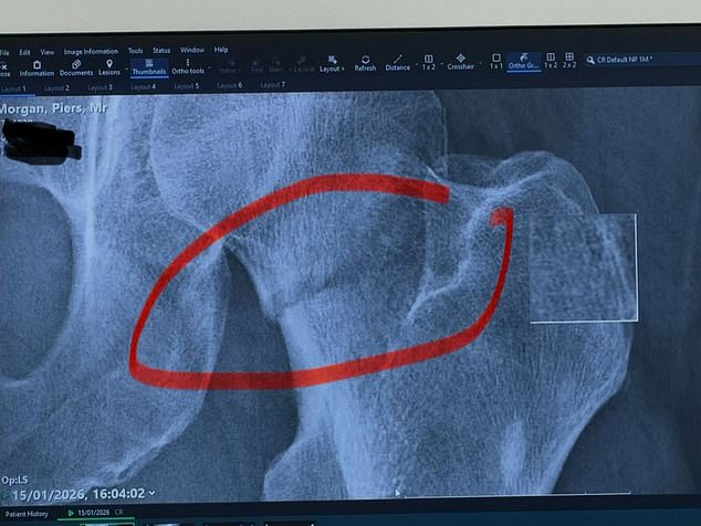 Mr Morgan explained that he fractured the neck of his femur after tripping on a small step inside a London hotel restaurant