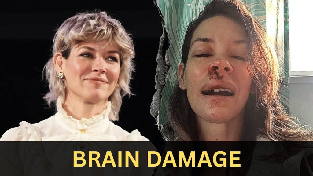 Evangeline Lilly Reveals Brain Damage After Freak Accident — What Happened? Evangeline Lilly Reveals Brain Damage After Freak Accident — What Happened?