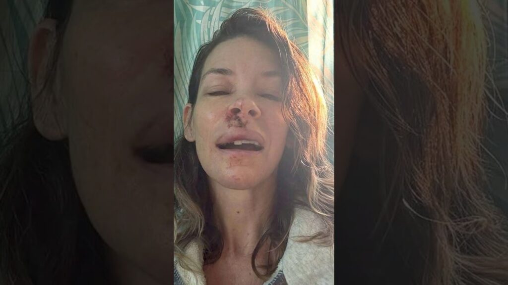 Evangeline Lilly Says She Has Brain Damage