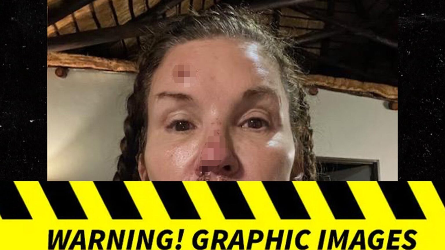Janice Dickinson's Photos of Alleged Injuries From Nasty Fall on 'I'm A Celebrity'