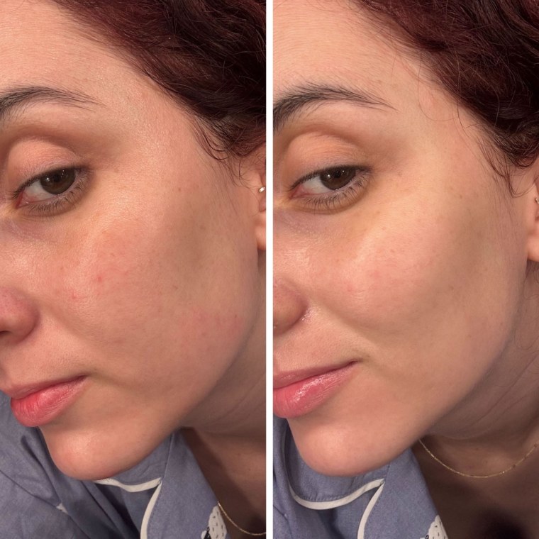 Before and after of woman using a Biodance face mask