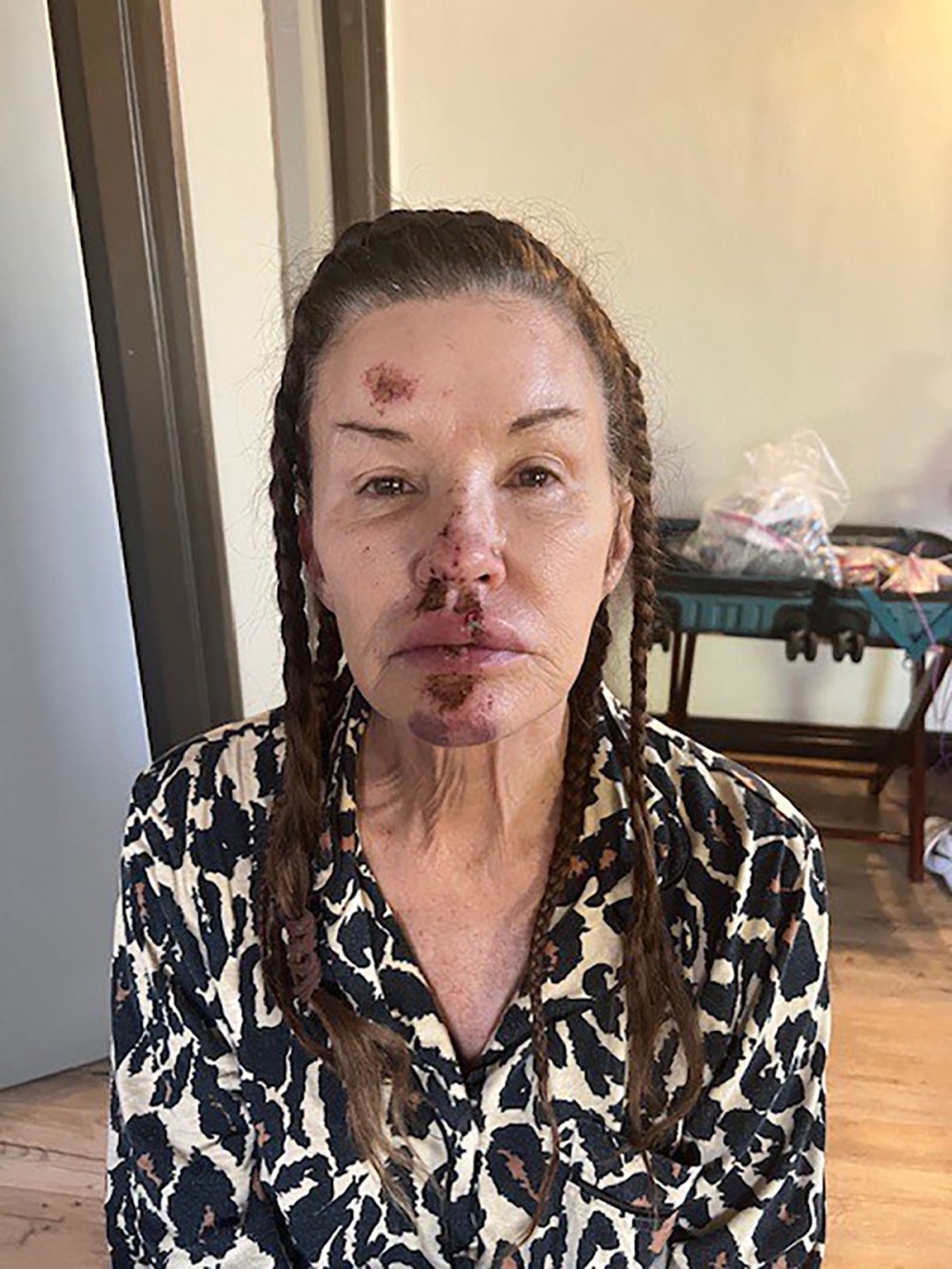 Janice Dickenson Shares Photos From Brutal On Set Injury