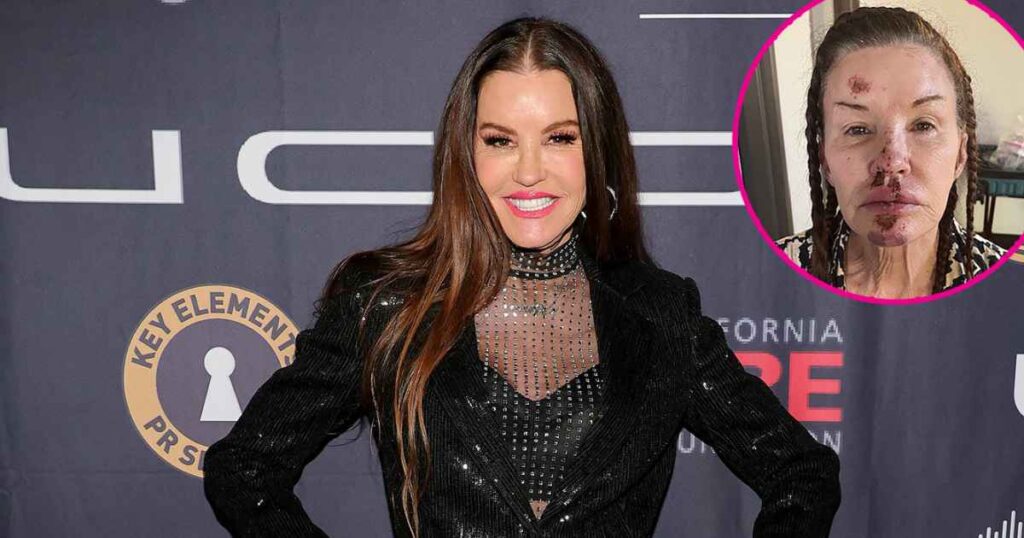 Janice Dickinson Shares Photos From Brutal On-Set Injury Amid Lawsuit