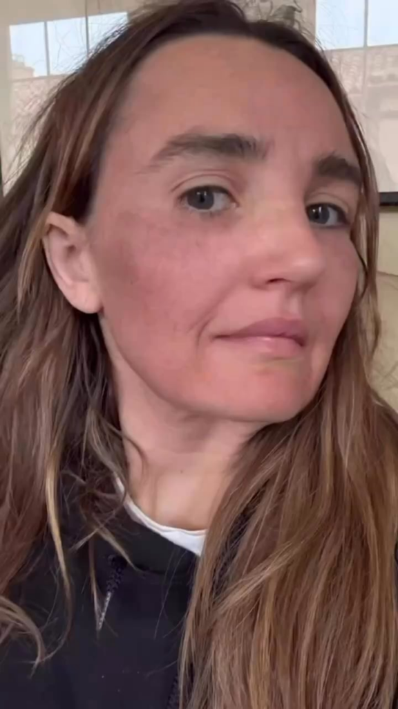 Chloe Fineman Shares 'Botched' iPhone Photos of Cosmetic Procedures “Every year, hundreds of women will say they're going on a trip or visiting family in Connecticut. But really, they'll be going ham at a med spa.”
