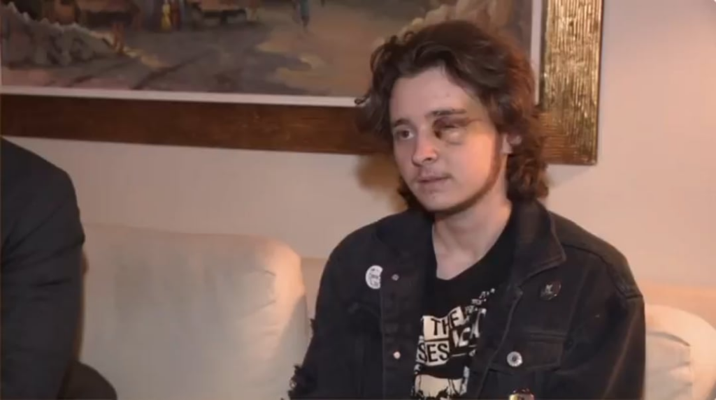 21-year-old guy injured by ICE: I will be blind for life. I have fractures in my skull that they can't fix. I can't sneeze or cough because it's dangerous to. They pulled a piece of plastic the size of a nickel out of my eye. I had shards of metal, glass, and plastic behind my eye and in my skull