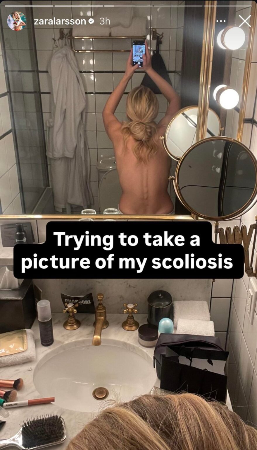 Zara Larsson shares she has scoliosis