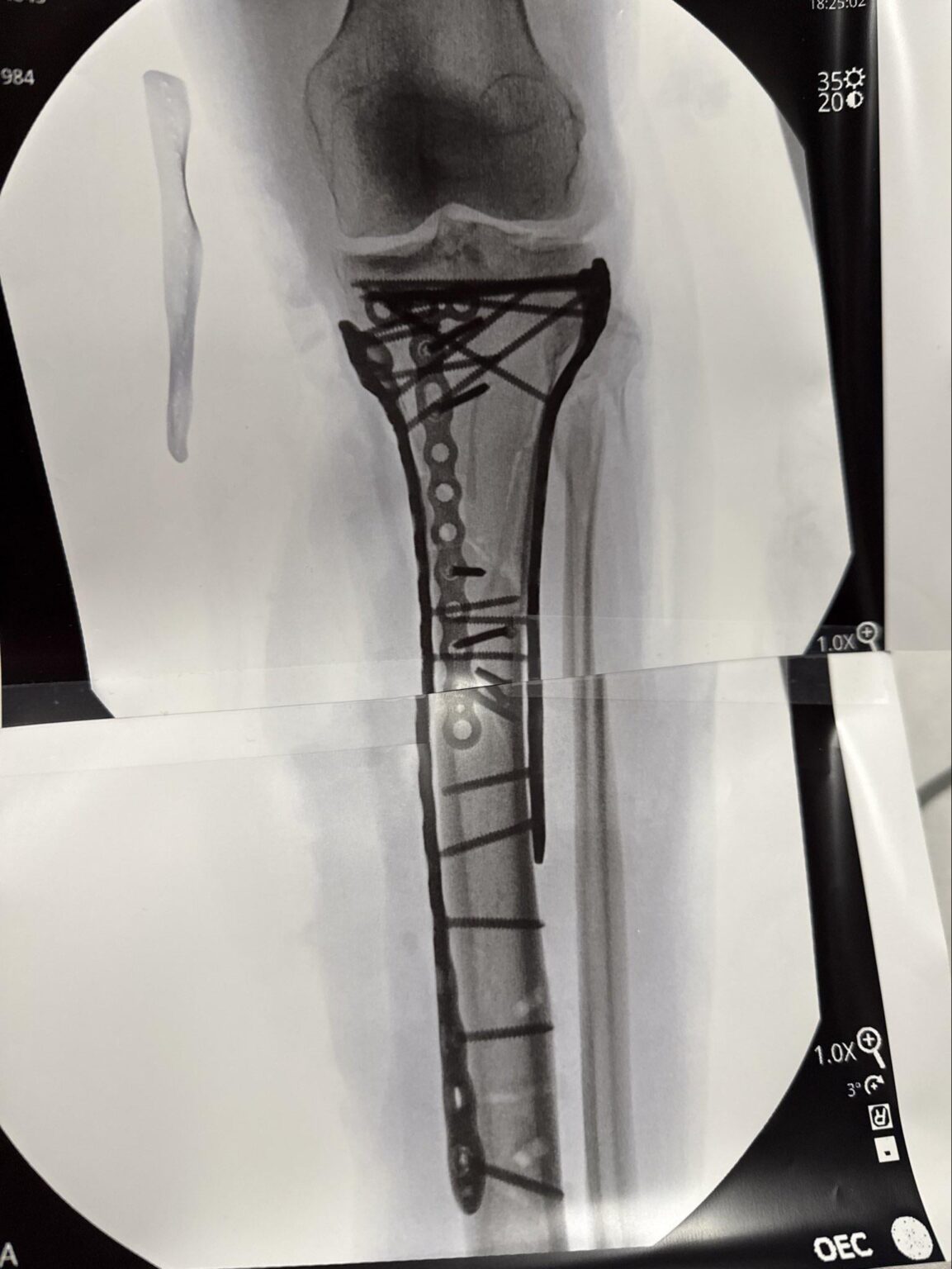 Lindsey Vonn in new IG post: Made it through surgery it took a bit more than 6 hours to complete. As you can see, it required a lot of plates and screws to put back together but Dr Hackett did an incredible job. Thank you Dr Viola for the surgery assist as well!!