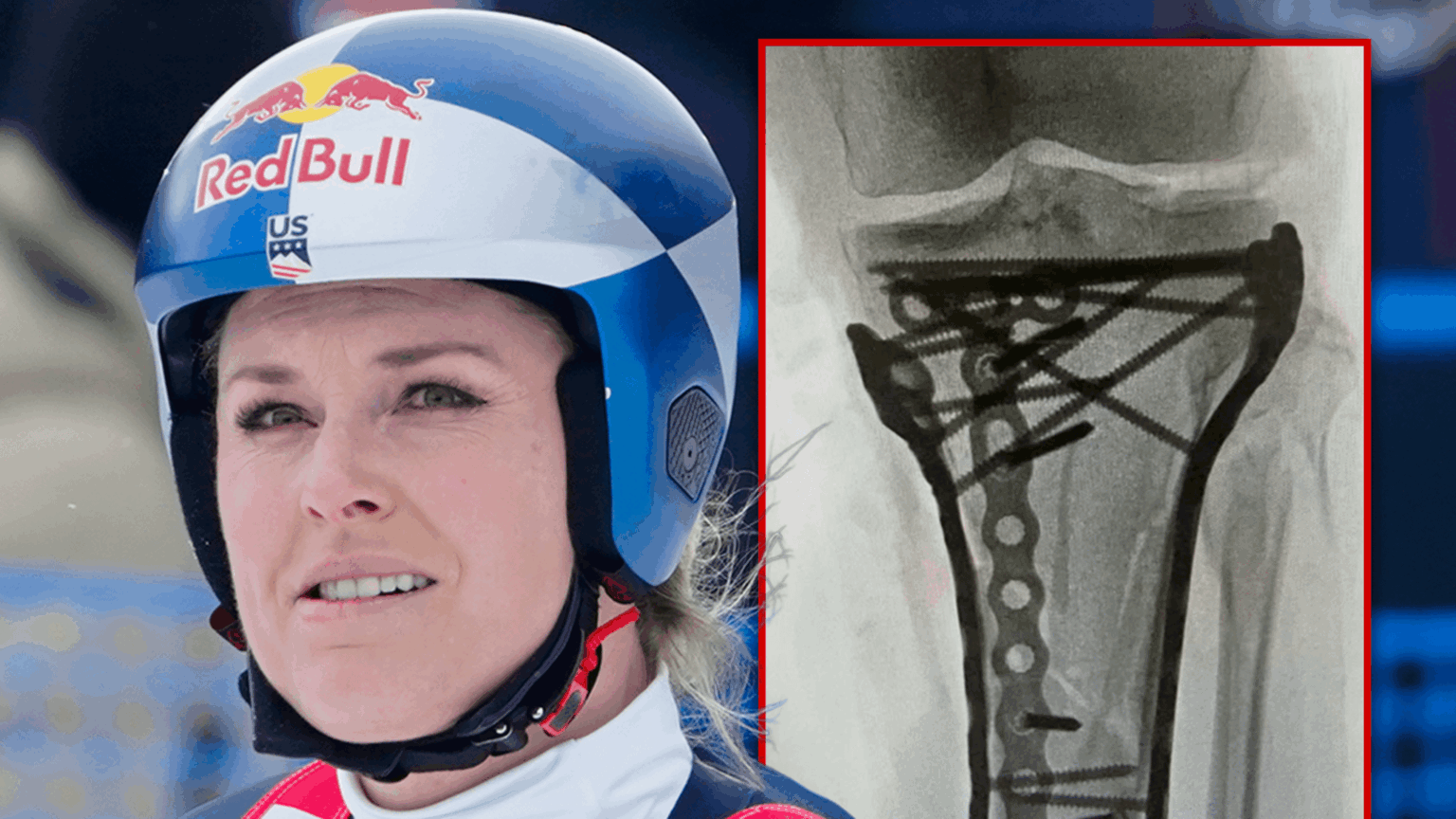 Lindsey Vonn 'Struggling' After Last Surgery, Remains Hospitalized in U.S.