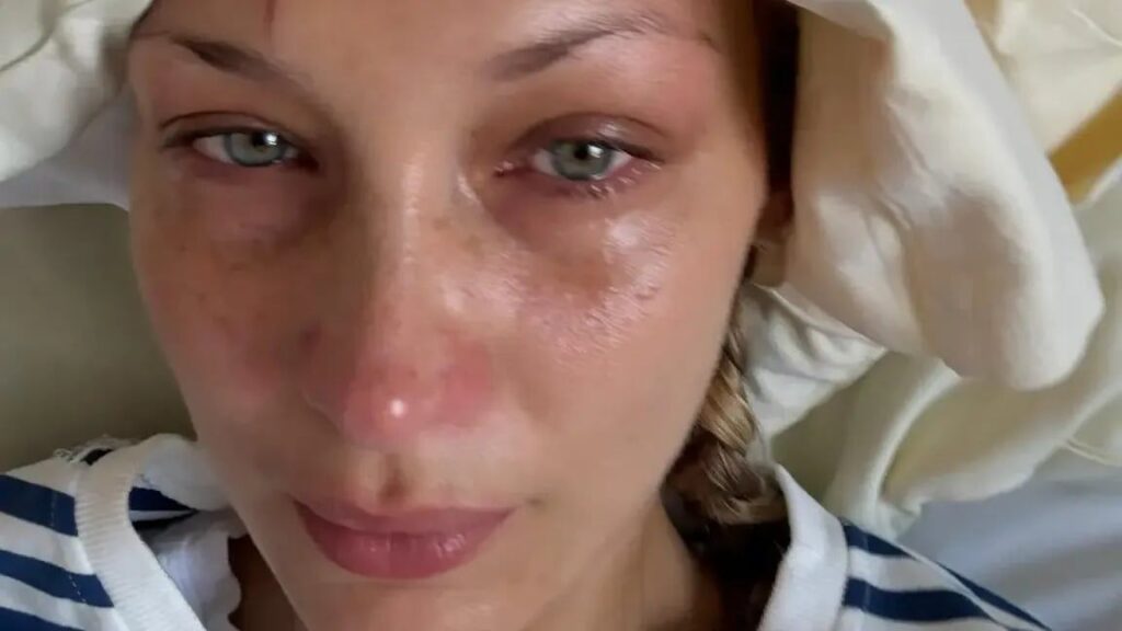 Bella Hadid shares sad reality of battling with disease common among celebrities