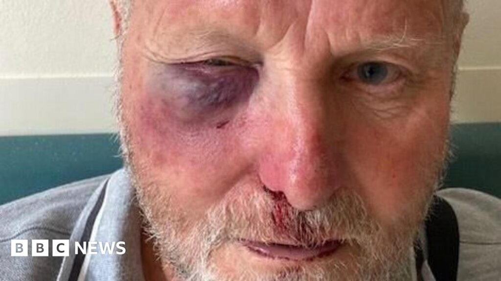 Christopher Lavis' is pictured with a black eye and broken nose with blood on his face and swelling on his cheek.
