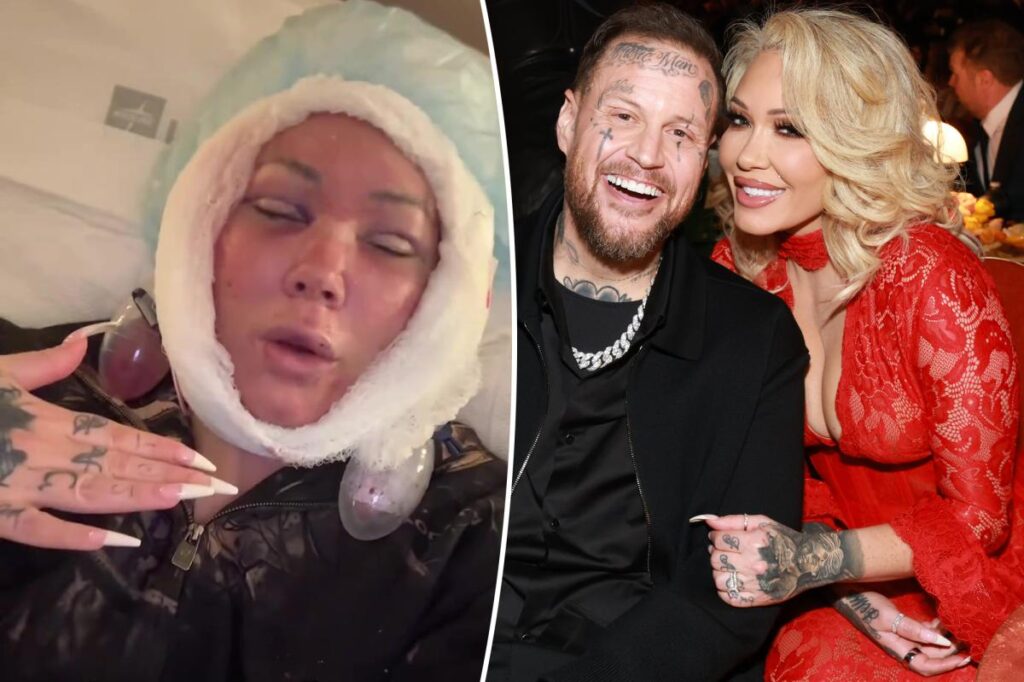 Jelly Roll’s wife, Bunnie Xo, unveils gruesome aftermath of facelift Jelly Roll's wife, Bunnie Xo, unveils gruesome aftermath of facelift