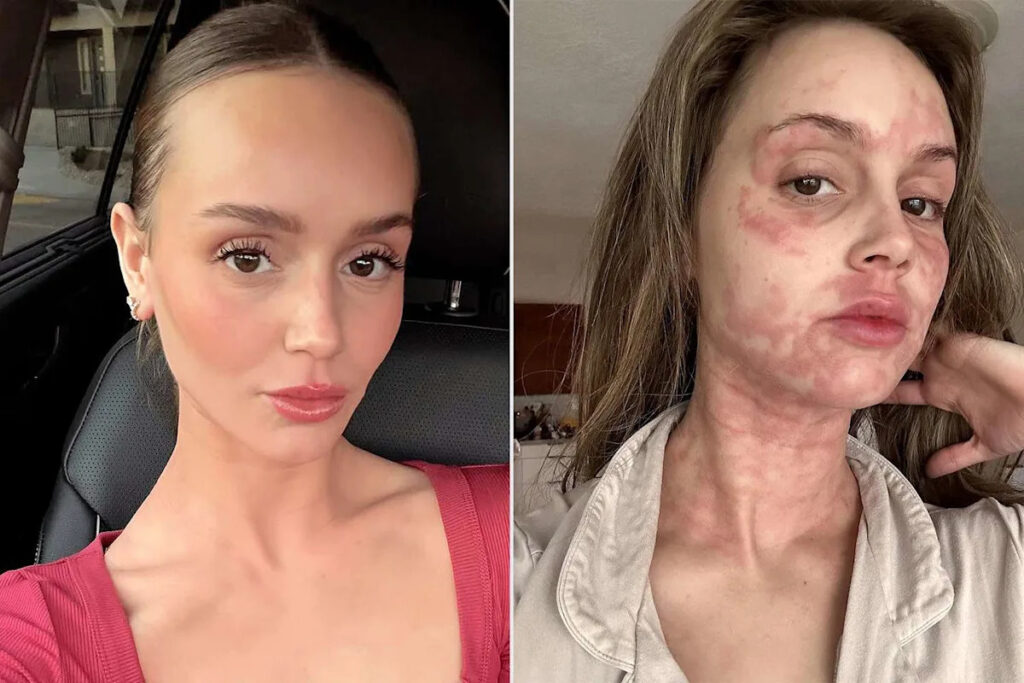 Mikayla Matthews Says She's 'Barely Surviving' as She Reveals the Name of Her Chronic Illness