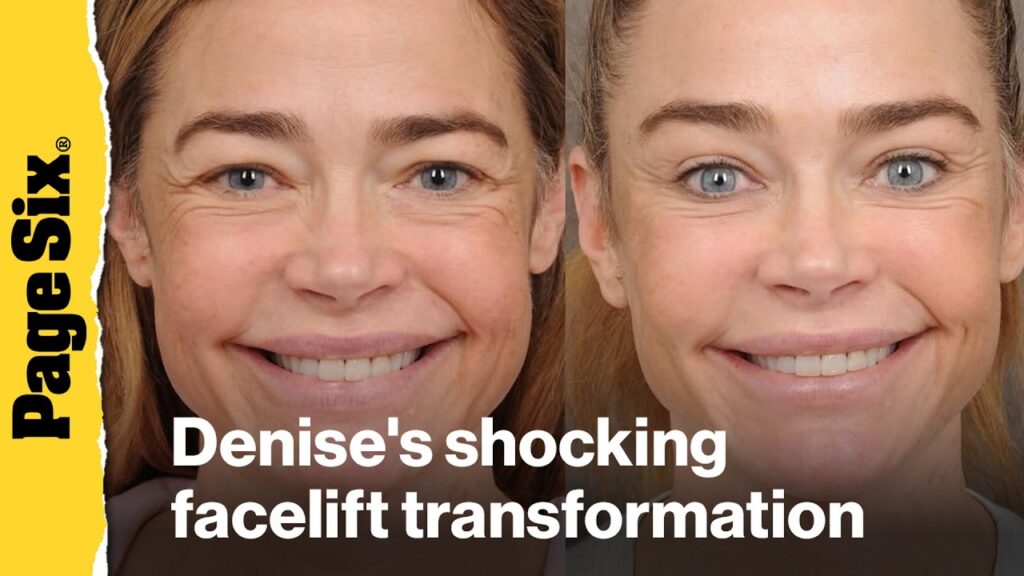 Denise Richards shares wild before-and-after photos of shocking facelift transformation