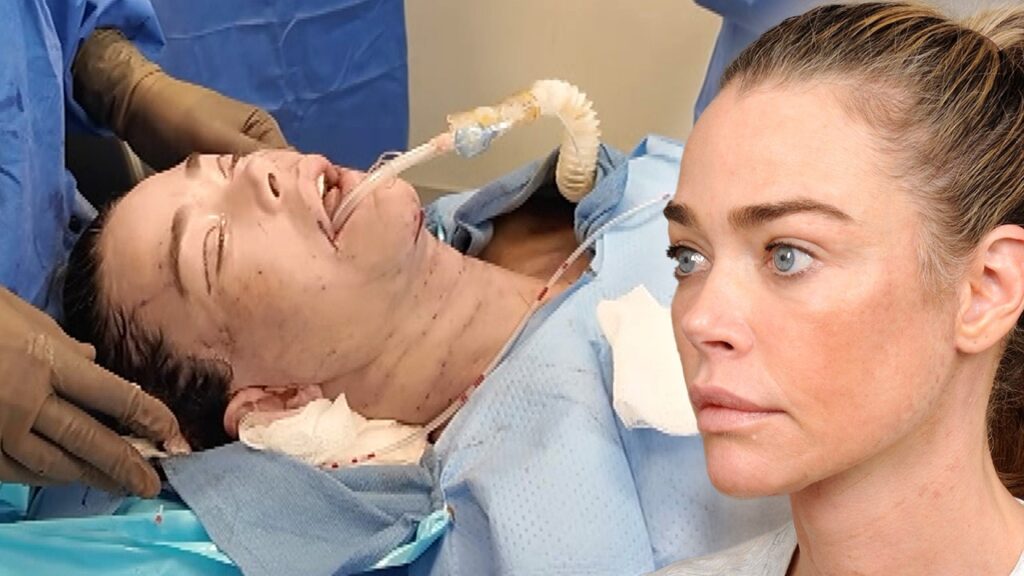 Inside Denise Richards' Facelift: Never-Before-Seen Footage From Shocking Transformation (Exclusive)