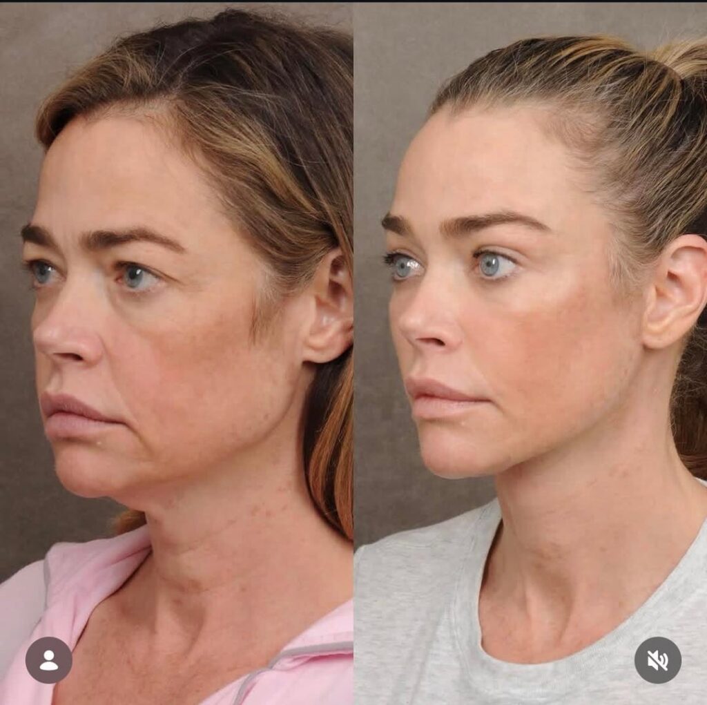 Denise Richards plastic surgeon Dr. Ben Talei posts before and after pictures of her facial surgeries