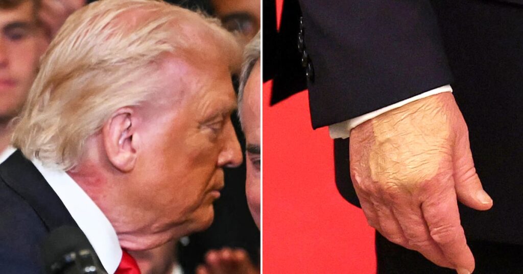 Trump, 79, Slathers Makeup on Bruised Hand But Can’t Hide Neck Rash