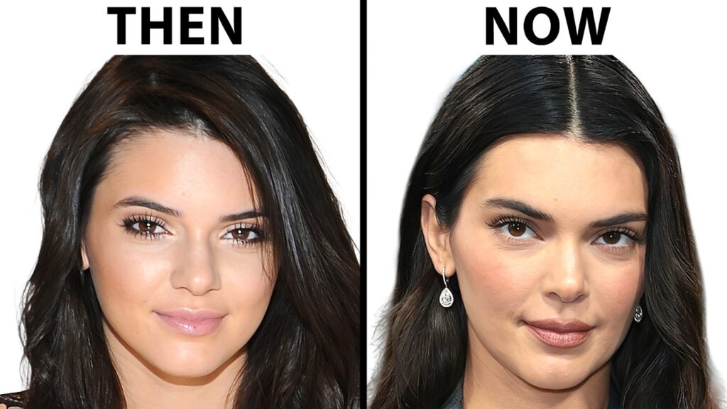 Kendall Jenner's NEW FACE | Plastic Surgery Analysis
