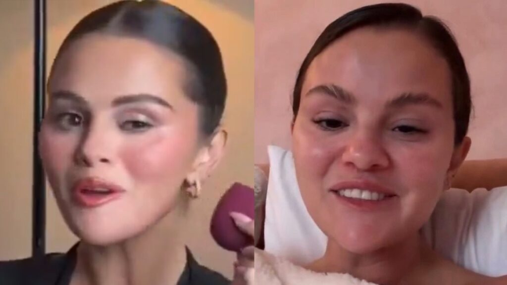 Selena Gomez ADDICTION To Fillers Is DESTROYING Her Face