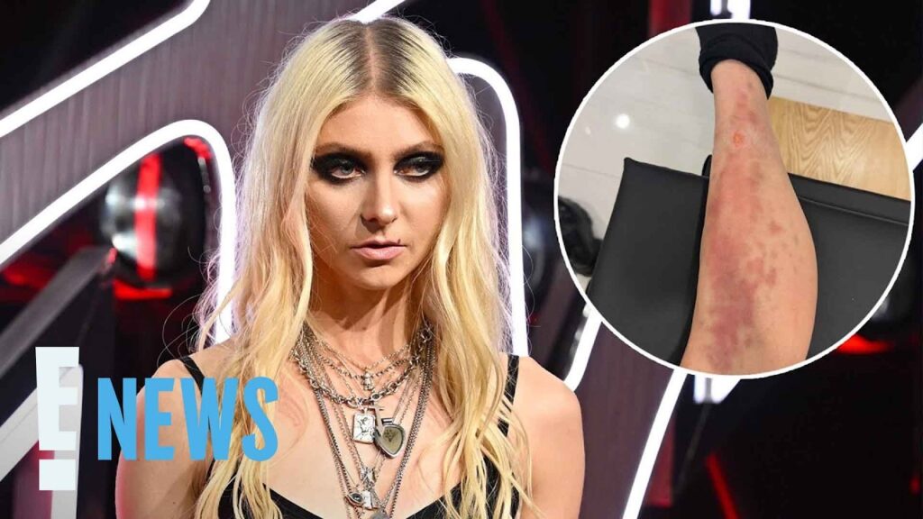 Taylor Momsen Hospitalized After Suffering Poisonous Spider Bite | E! News