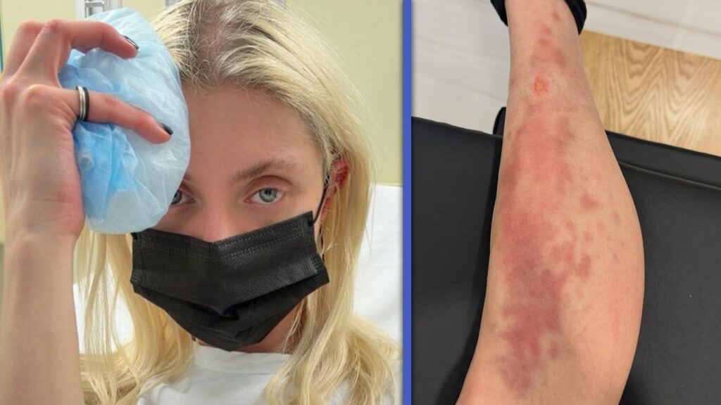 Taylor Momsen Shows Off SHOCKING Spider Bite That Forced HOSPITALIZATION 2 Years After BAT ATTACK!