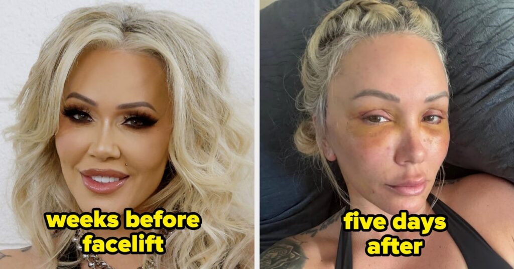 Celebrities Before And After Facelifts Celebrities Before And After Facelifts
