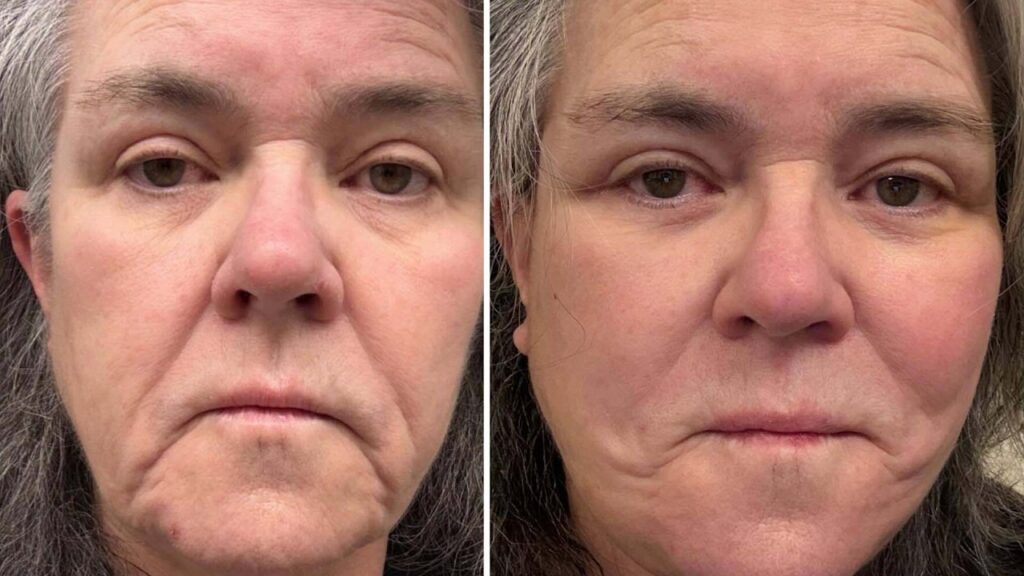 Rosie O'Donnell Reveals SECRET Facelift That Cost More Than a Car