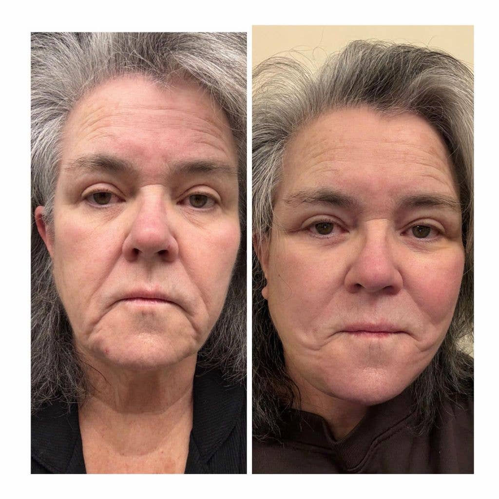 split photo of rosie o'donnell before and after facelift