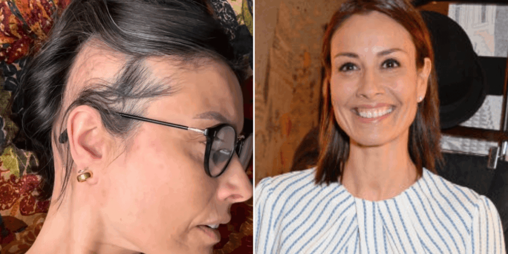 Melanie Sykes reveals hair loss amid alopecia battle as TV star claims 'I'm two-thirds bald'