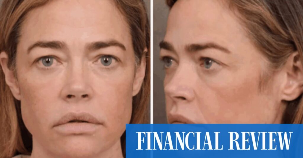 Celebrities like Denise Richards and Kylie Jenner are reframing plastic surgery as self-care Celebrities like Denise Richards and Kylie Jenner are reframing plastic surgery as self-care