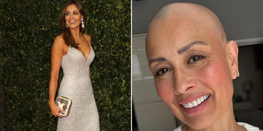 Melanie Sykes proudly reveals completely bald head after opening up about alopecia battle Melanie Sykes proudly reveals completely bald head after opening up about alopecia battle