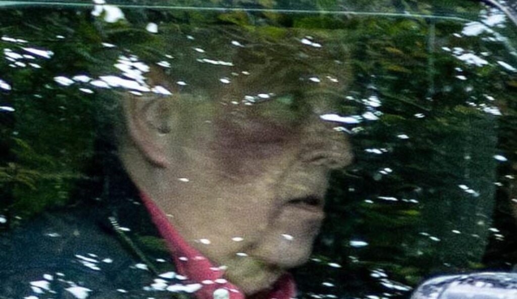 Andrew Mountbatten-Windsor is spotted with mystery bruise on his face near his Sandringham home