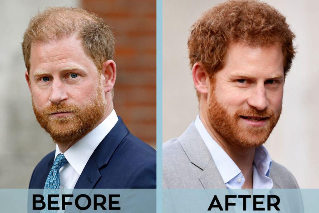 Has Prince Harry Had a Hair Transplant? Here’s What the Evidence Actually Says