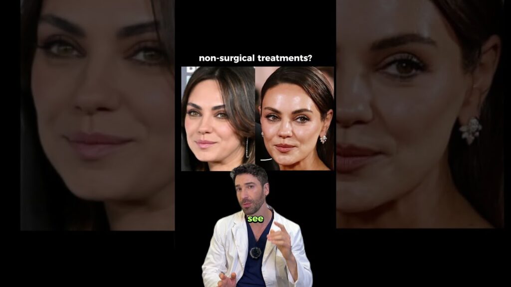 Did Mila Kunis refine her mid-to-lower face without changing her look?  #milakunis #facelift