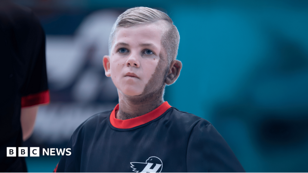 CMN birthmark no barrier for young footballing TV star A teenage boy wearing a sports kit looks up. He has blonde hair, blue eyes and a birthmark across one side of his face and neck.